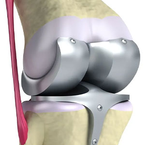 Joint-Replacement