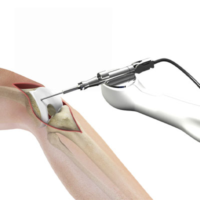 Robotic-Joint-replacement